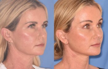 51 YR - 1 Month Postop: Endoscopic Browlift + Facelift