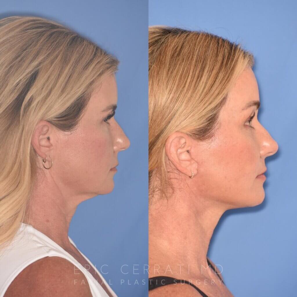 51 YR - 1 Month Postop: Endoscopic Browlift + Facelift