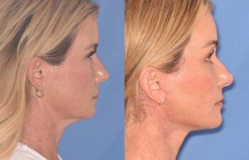 51 YR - 1 Month Postop: Endoscopic Browlift + Facelift
