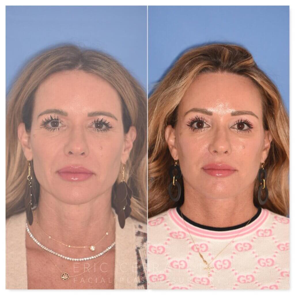 50 YR - 1 Month Postop: Endoscopic Browlift + Upper Blepharoplasty + Lower Skin Pinch + Facelift