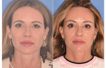 50 YR - 1 Month Postop: Endoscopic Browlift + Upper Blepharoplasty + Lower Skin Pinch + Facelift