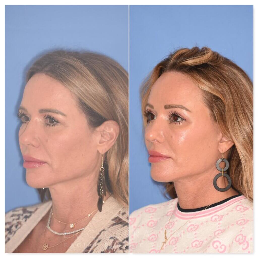 50 YR - 1 Month Postop: Endoscopic Browlift + Upper Blepharoplasty + Lower Skin Pinch + Facelift