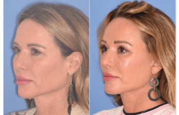 50 YR - 1 Month Postop: Endoscopic Browlift + Upper Blepharoplasty + Lower Skin Pinch + Facelift