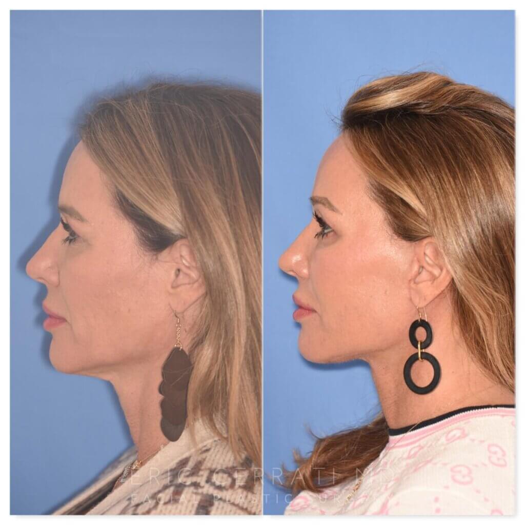 50 YR - 1 Month Postop: Endoscopic Browlift + Upper Blepharoplasty + Lower Skin Pinch + Facelift