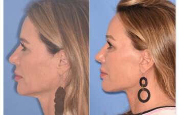 50 YR - 1 Month Postop: Endoscopic Browlift + Upper Blepharoplasty + Lower Skin Pinch + Facelift