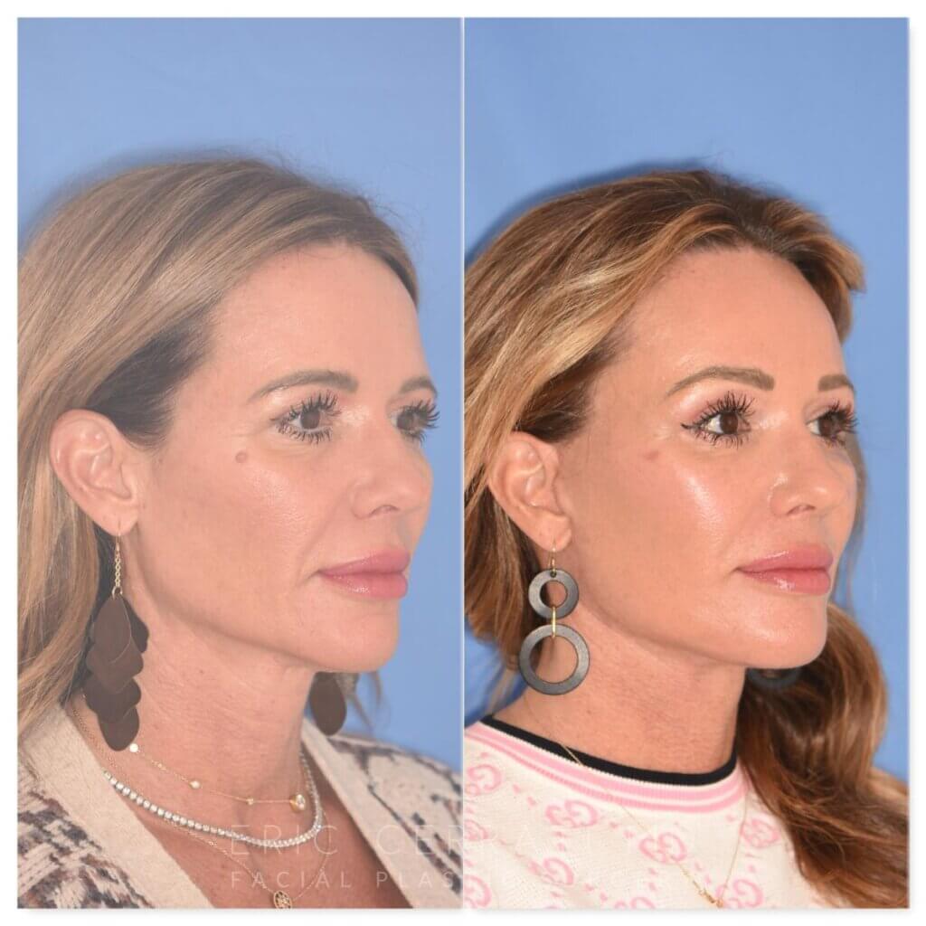 50 YR - 1 Month Postop: Endoscopic Browlift + Upper Blepharoplasty + Lower Skin Pinch + Facelift