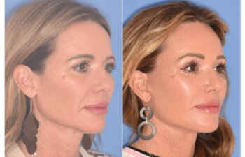 50 YR - 1 Month Postop: Endoscopic Browlift + Upper Blepharoplasty + Lower Skin Pinch + Facelift