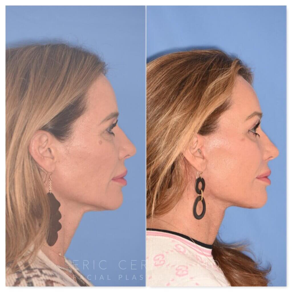 50 YR - 1 Month Postop: Endoscopic Browlift + Upper Blepharoplasty + Lower Skin Pinch + Facelift