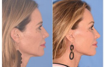 50 YR - 1 Month Postop: Endoscopic Browlift + Upper Blepharoplasty + Lower Skin Pinch + Facelift