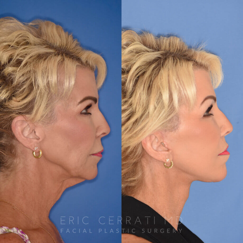 60 YR - 3.5 Months Postop: Facelift + Liplift + Fat Grafting + Laser