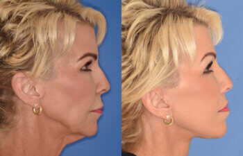 60 YR - 3.5 Months Postop: Facelift + Liplift + Fat Grafting + Laser