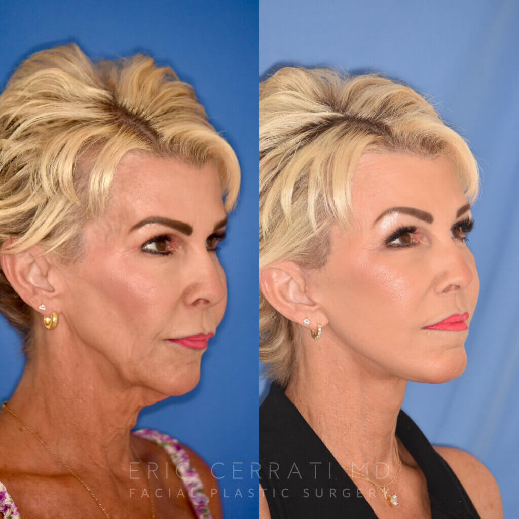60 YR - 3.5 Months Postop: Facelift + Liplift + Fat Grafting + Laser