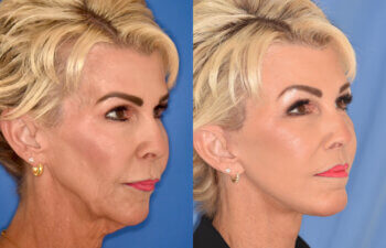 60 YR - 3.5 Months Postop: Facelift + Liplift + Fat Grafting + Laser