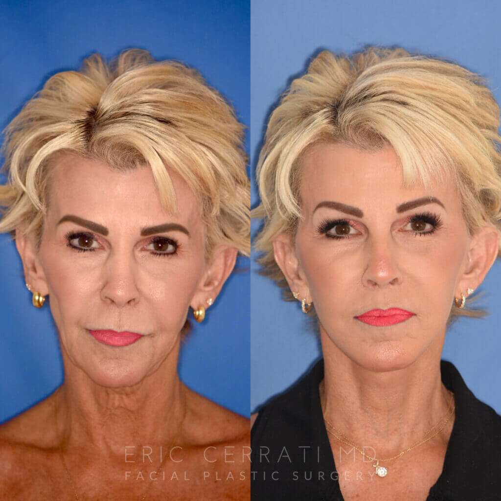 60 YR - 3.5 Months Postop: Facelift + Liplift + Fat Grafting + Laser