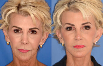 60 YR - 3.5 Months Postop: Facelift + Liplift + Fat Grafting + Laser