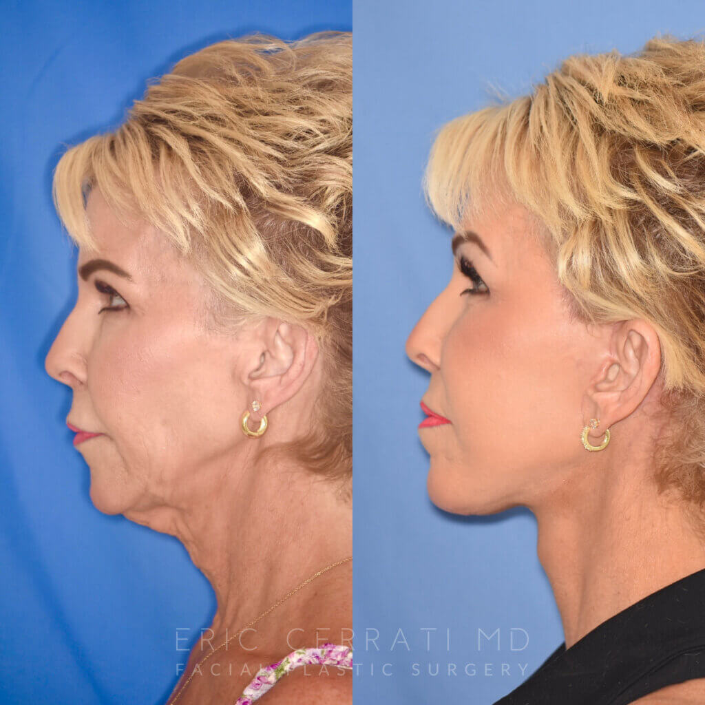60 YR - 3.5 Months Postop: Facelift + Liplift + Fat Grafting + Laser