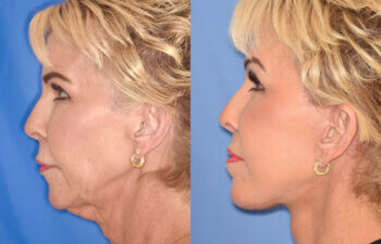 60 YR - 3.5 Months Postop: Facelift + Liplift + Fat Grafting + Laser