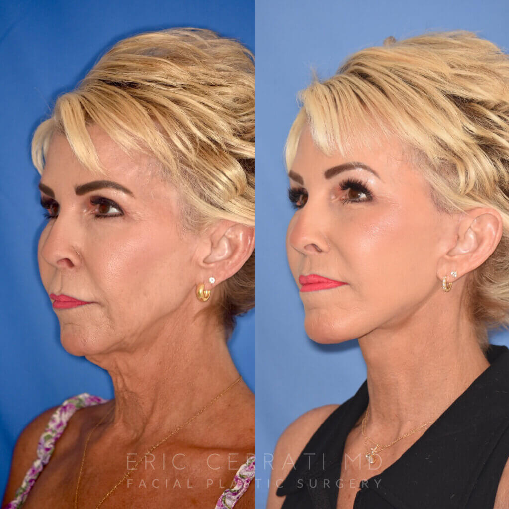 60 YR - 3.5 Months Postop: Facelift + Liplift + Fat Grafting + Laser