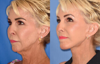 60 YR - 3.5 Months Postop: Facelift + Liplift + Fat Grafting + Laser