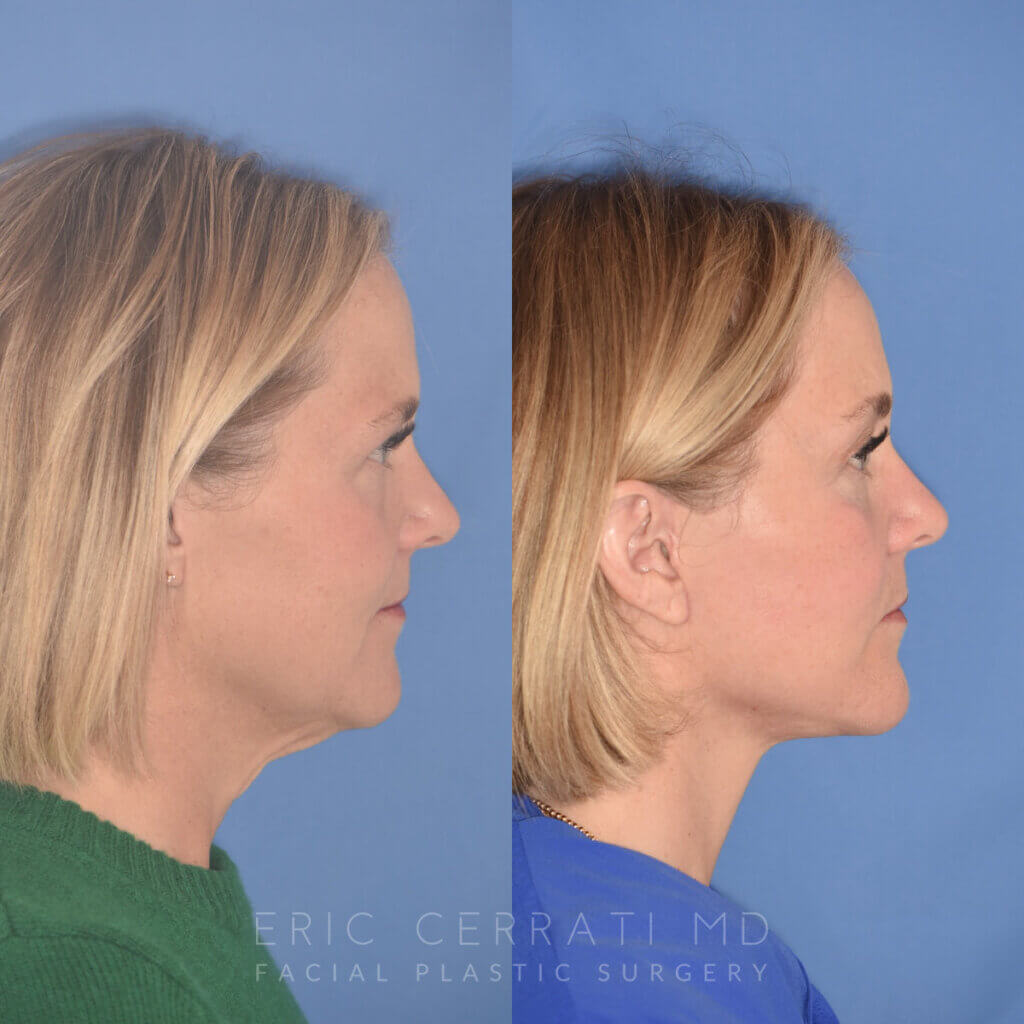 50 YR - 3 Months Postop: Endoscopic Browlift + Lower Blepharoplasty + Facelift