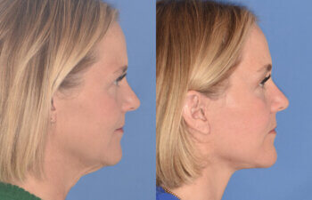 50 YR - 3 Months Postop: Endoscopic Browlift + Lower Blepharoplasty + Facelift