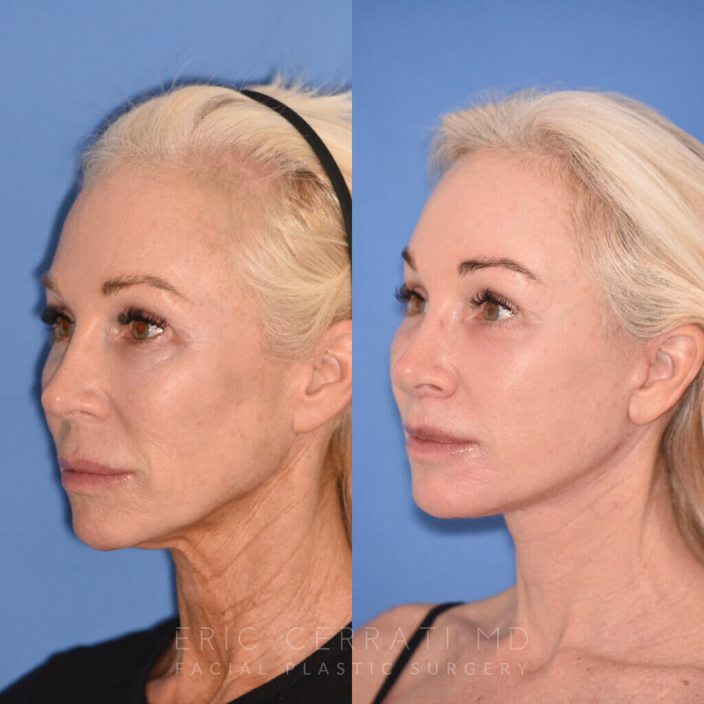 50 YR - 1 Month Postop: Endoscopic Browlift + Revision Lower Blepharoplasty + Fat Grafting + Facelift + Liplift + Laser