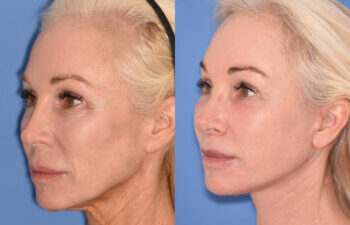 50 YR - 1 Month Postop: Endoscopic Browlift + Revision Lower Blepharoplasty + Fat Grafting + Facelift + Liplift + Laser