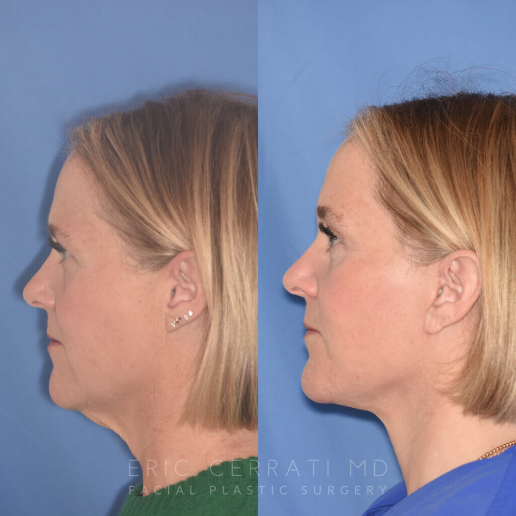 50 YR - 3 Months Postop: Endoscopic Browlift + Lower Blepharoplasty + Facelift
