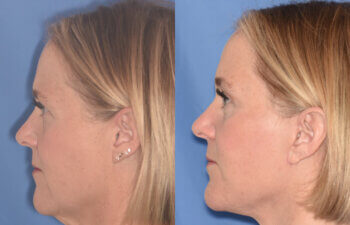 50 YR - 3 Months Postop: Endoscopic Browlift + Lower Blepharoplasty + Facelift