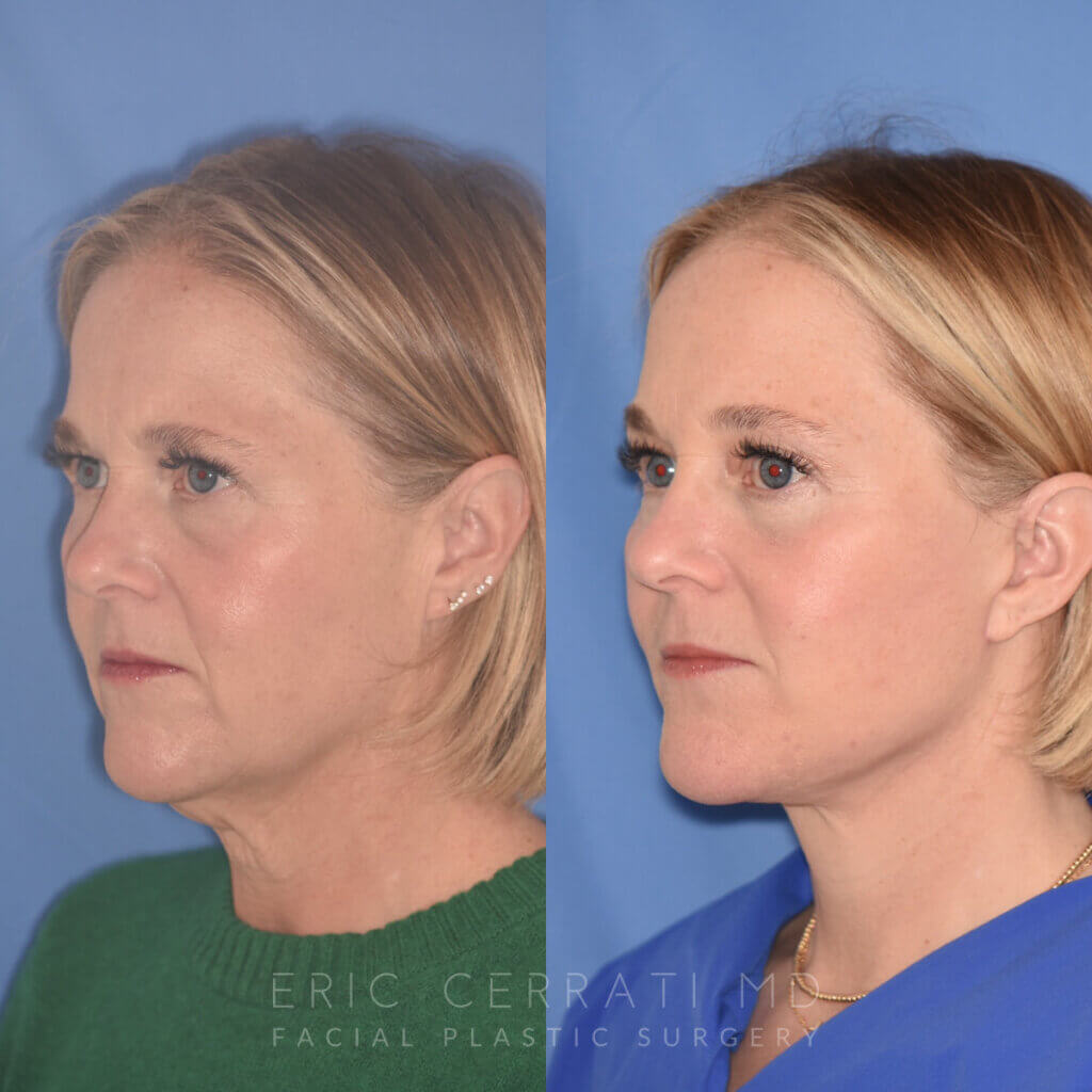 50 YR - 3 Months Postop: Endoscopic Browlift + Lower Blepharoplasty + Facelift