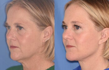 50 YR - 3 Months Postop: Endoscopic Browlift + Lower Blepharoplasty + Facelift