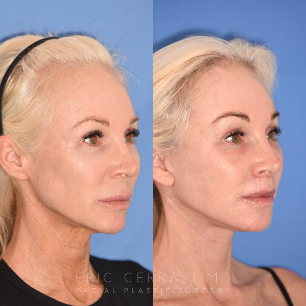 50 YR - 1 Month Postop: Endoscopic Browlift + Revision Lower Blepharoplasty + Fat Grafting + Facelift + Liplift + Laser