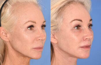 50 YR - 1 Month Postop: Endoscopic Browlift + Revision Lower Blepharoplasty + Fat Grafting + Facelift + Liplift + Laser