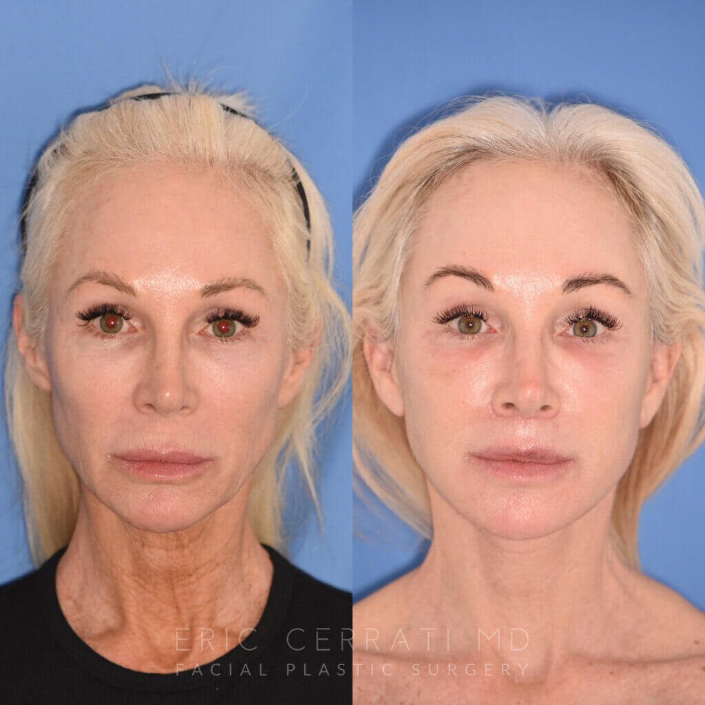 50 YR - 1 Month Postop: Endoscopic Browlift + Revision Lower Blepharoplasty + Fat Grafting + Facelift + Liplift + Laser