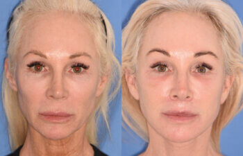 50 YR - 1 Month Postop: Endoscopic Browlift + Revision Lower Blepharoplasty + Fat Grafting + Facelift + Liplift + Laser