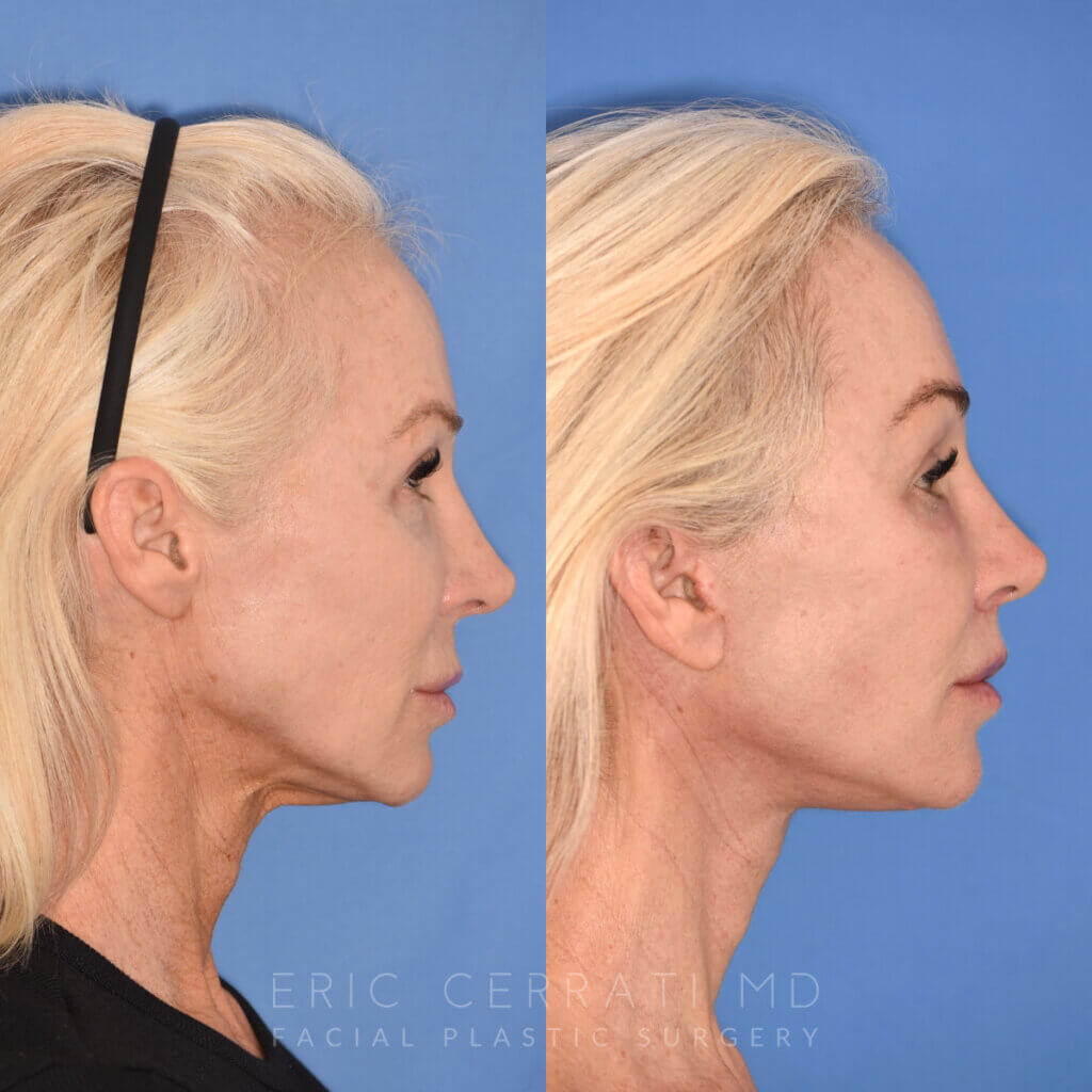 50 YR - 1 Month Postop: Endoscopic Browlift + Revision Lower Blepharoplasty + Fat Grafting + Facelift + Liplift + Laser