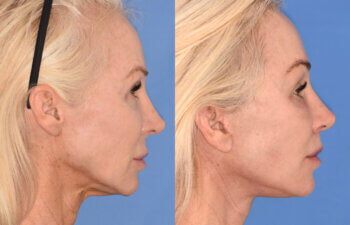 50 YR - 1 Month Postop: Endoscopic Browlift + Revision Lower Blepharoplasty + Fat Grafting + Facelift + Liplift + Laser