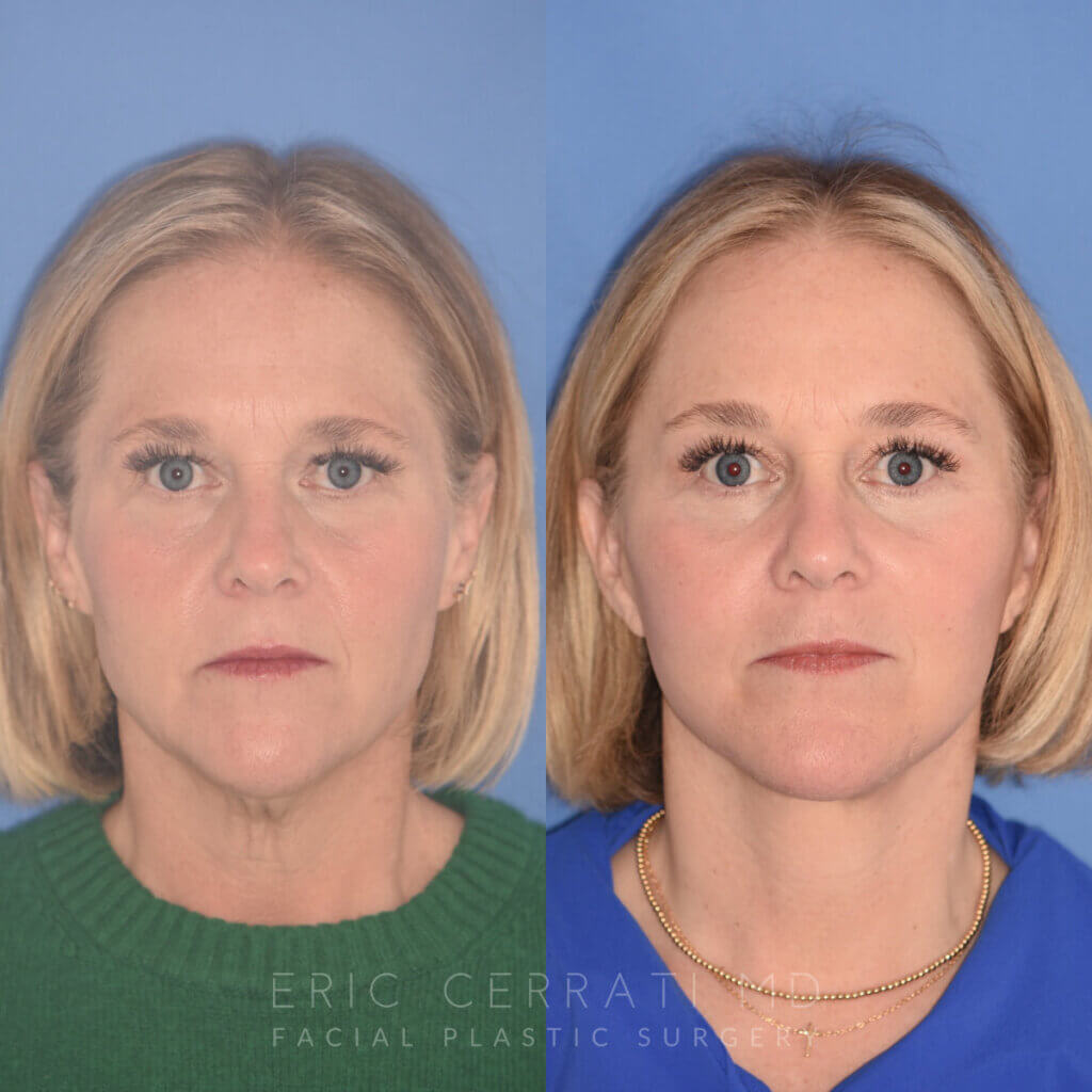 50 YR - 3 Months Postop: Endoscopic Browlift + Lower Blepharoplasty + Facelift