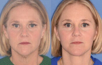 50 YR - 3 Months Postop: Endoscopic Browlift + Lower Blepharoplasty + Facelift