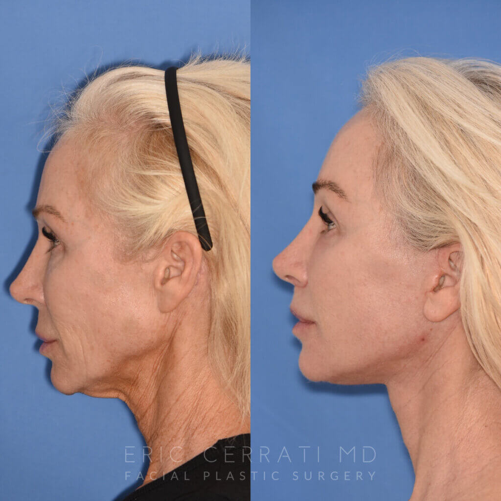 50 YR - 1 Month Postop: Endoscopic Browlift + Revision Lower Blepharoplasty + Fat Grafting + Facelift + Liplift + Laser