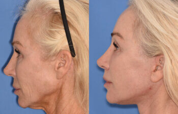 50 YR - 1 Month Postop: Endoscopic Browlift + Revision Lower Blepharoplasty + Fat Grafting + Facelift + Liplift + Laser