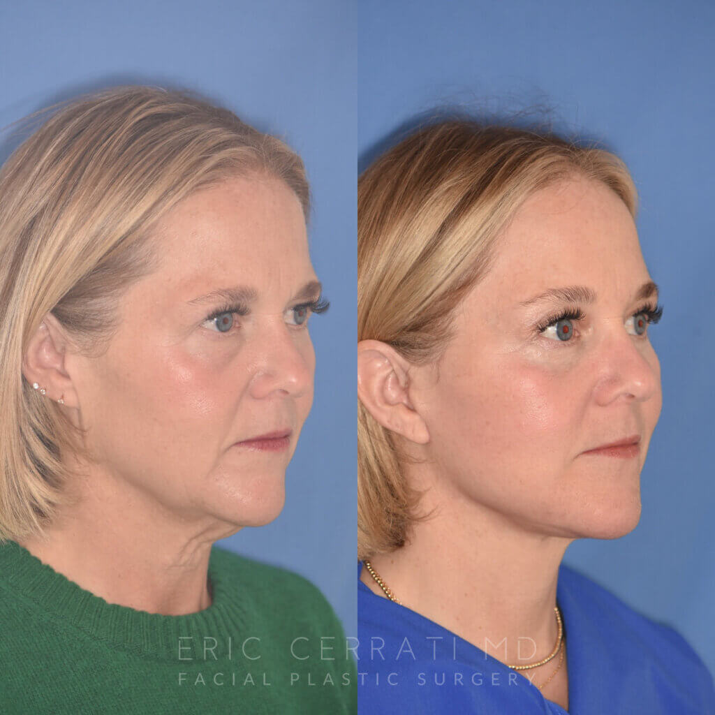 50 YR - 3 Months Postop: Endoscopic Browlift + Lower Blepharoplasty + Facelift