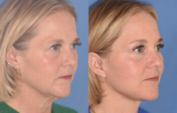 50 YR - 3 Months Postop: Endoscopic Browlift + Lower Blepharoplasty + Facelift