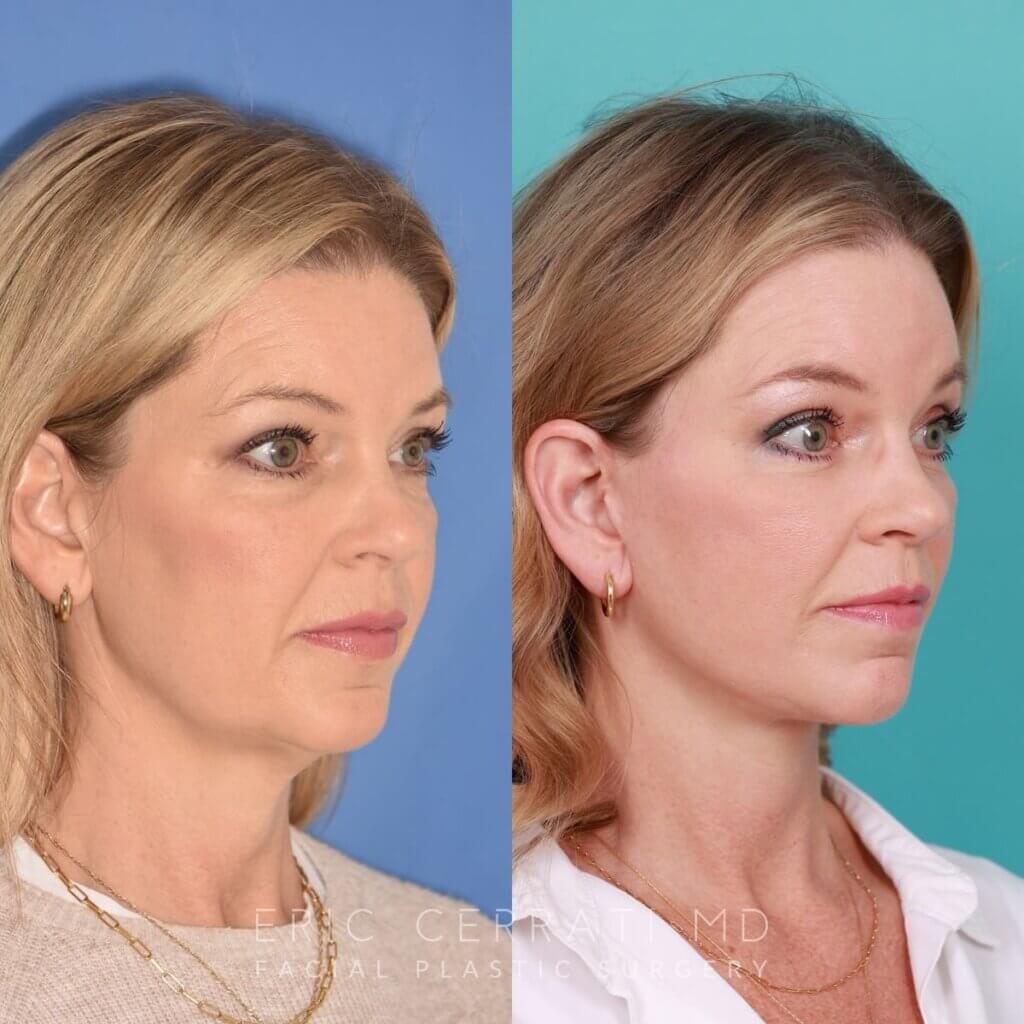54 YR - 8 Months Postop: Endoscopic Browlift + Lower Blepharoplasty + Facelift + Buccal Fat Reduction + Fat Grafting + Laser