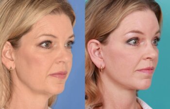 54 YR - 8 Months Postop: Endoscopic Browlift + Lower Blepharoplasty + Facelift + Buccal Fat Reduction + Fat Grafting + Laser