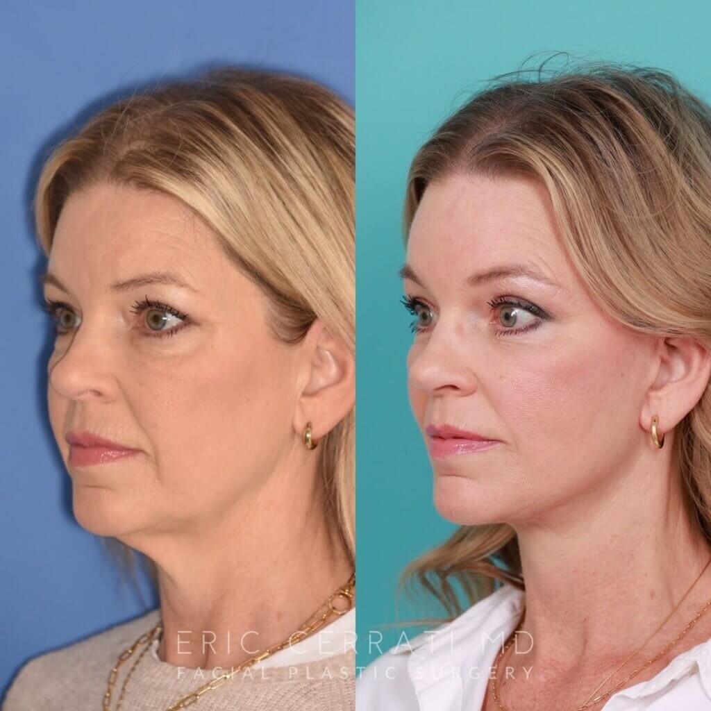 54 YR - 8 Months Postop: Endoscopic Browlift + Lower Blepharoplasty + Facelift + Buccal Fat Reduction + Fat Grafting + Laser