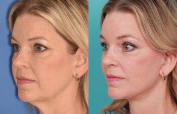 54 YR - 8 Months Postop: Endoscopic Browlift + Lower Blepharoplasty + Facelift + Buccal Fat Reduction + Fat Grafting + Laser