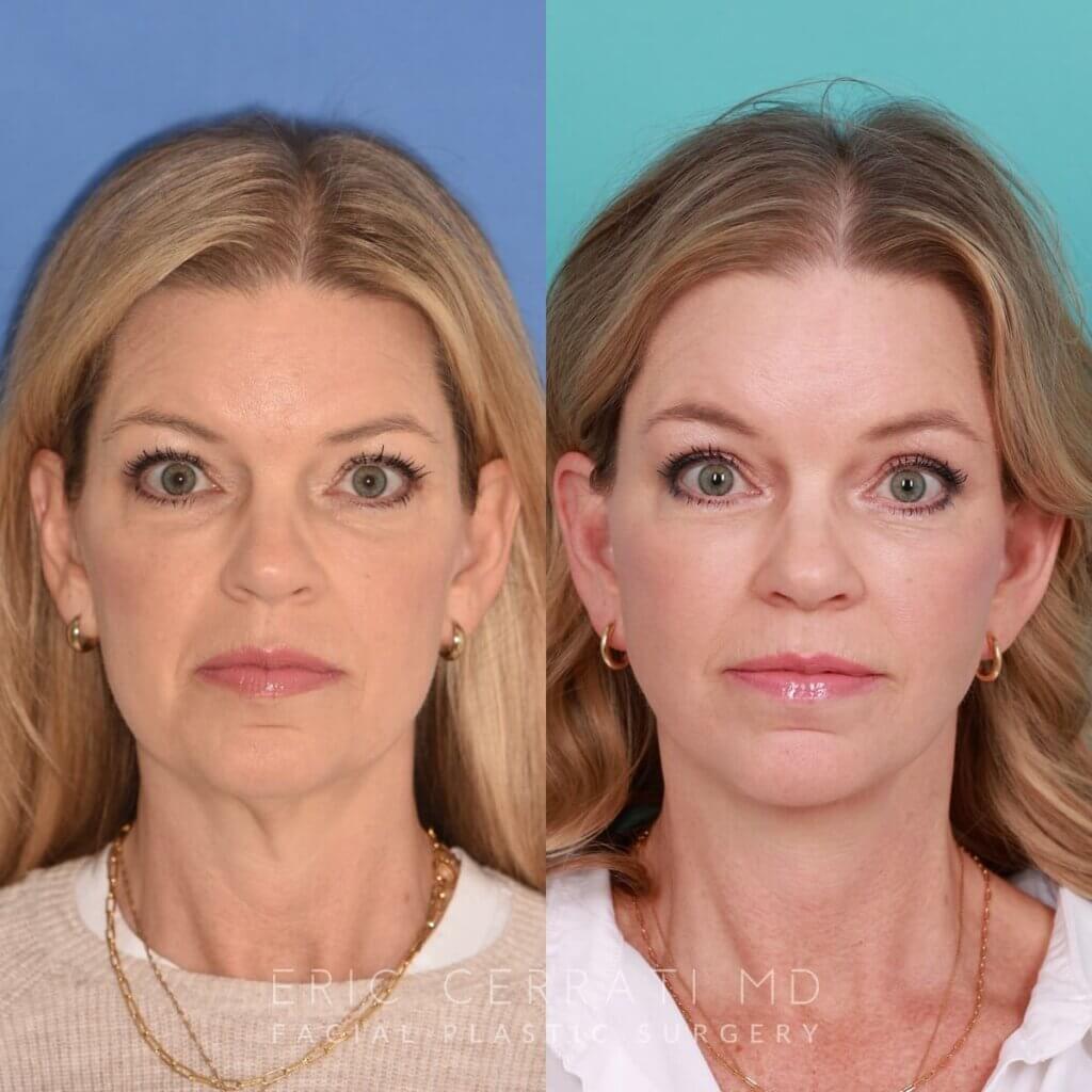 54 YR - 8 Months Postop: Endoscopic Browlift + Lower Blepharoplasty + Facelift + Buccal Fat Reduction + Fat Grafting + Laser