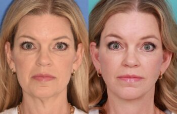 54 YR - 8 Months Postop: Endoscopic Browlift + Lower Blepharoplasty + Facelift + Buccal Fat Reduction + Fat Grafting + Laser