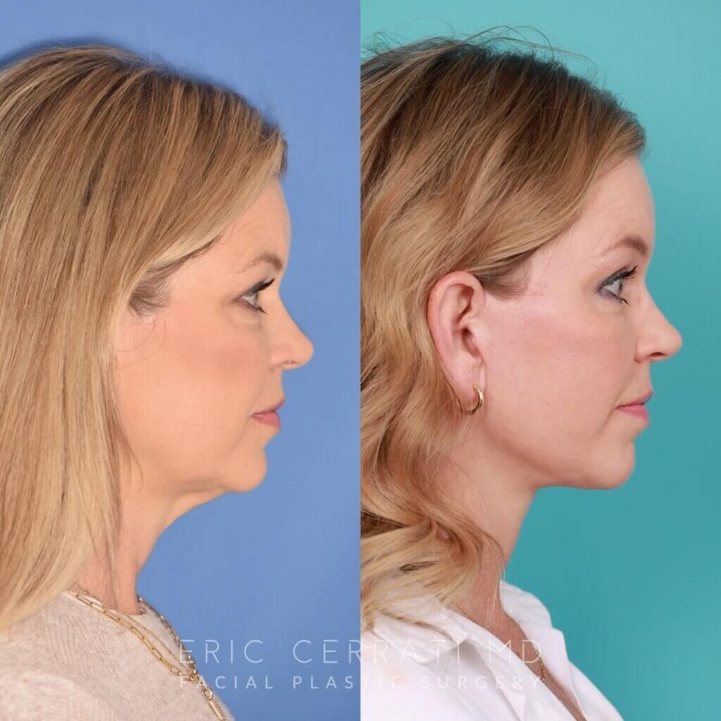 54 YR - 8 Months Postop: Endoscopic Browlift + Lower Blepharoplasty + Facelift + Buccal Fat Reduction + Fat Grafting + Laser